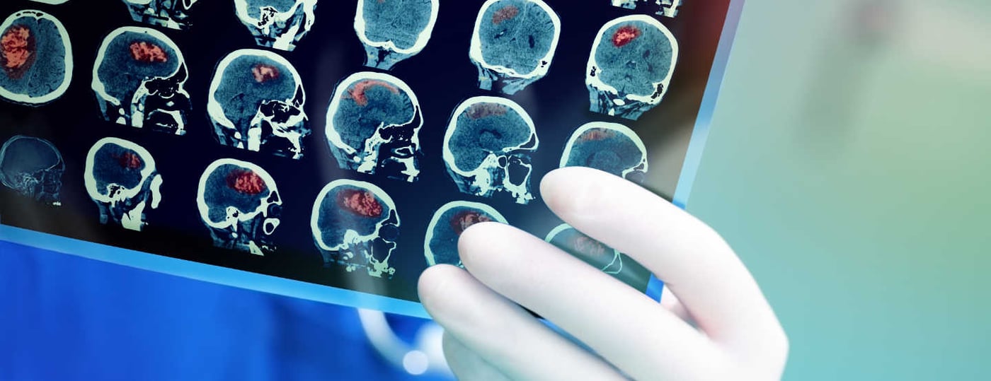 Schlaganfall erkennen